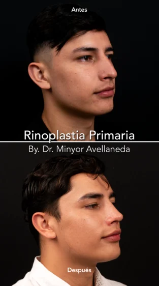 Rinoplastia Ultrasonica By Minyor Avellaneda