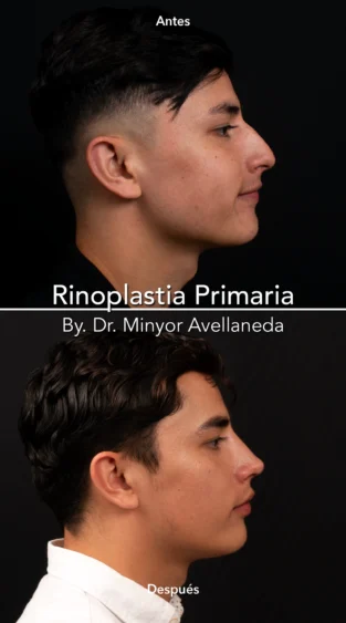 Rinoplastia Ultrasonica By Minyor Avellaneda