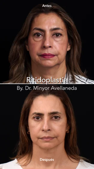 Ritidoplastia By Dr. Minyor Avellaneda