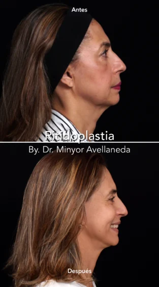 Ritidoplastia By Dr. Minyor Avellaneda