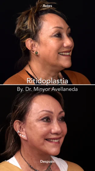 Ritidoplastia By Dr. Minyor Avellaneda