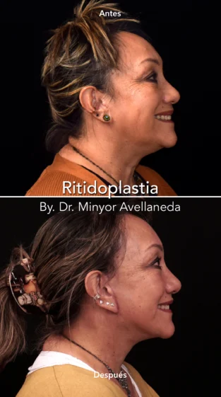 Ritidoplastia By Dr. Minyor Avellaneda