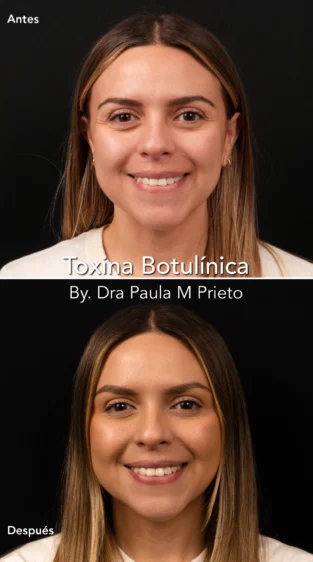 Toxina Botulínica por Dra Paula M Prieto