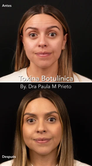 Toxina Botulínica por Dra Paula M Prieto