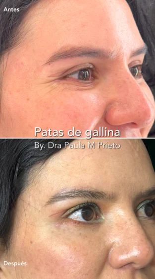 Toxina Botulínica por Dra Paula M Prieto