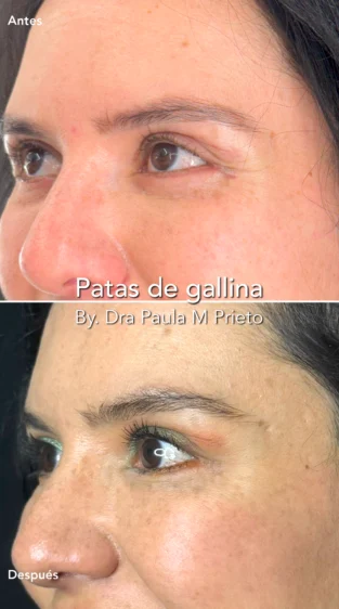 Toxina Botulínica por Dra Paula M Prieto