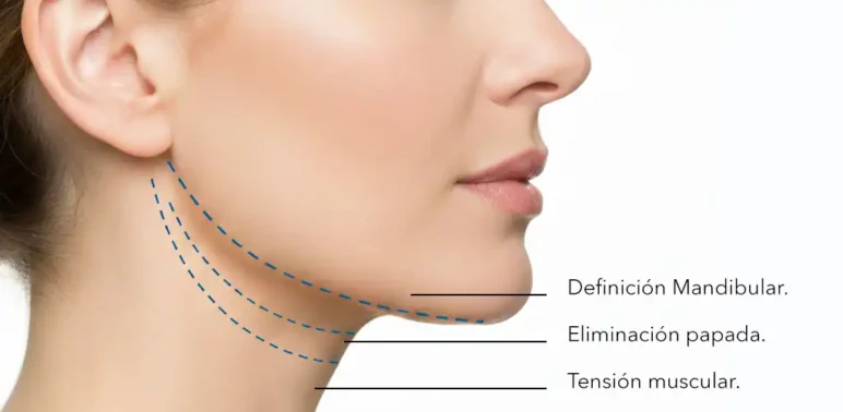 Cervicoplastia - Beneficios y Definición Mandibular Infografía de cervicoplastia mostrando definición mandibular, eliminación de papada y tensión muscular por Dr. Minyor Avellaneda.