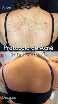 espalda_acne-01 espalda acne 01 Nuara Belleza