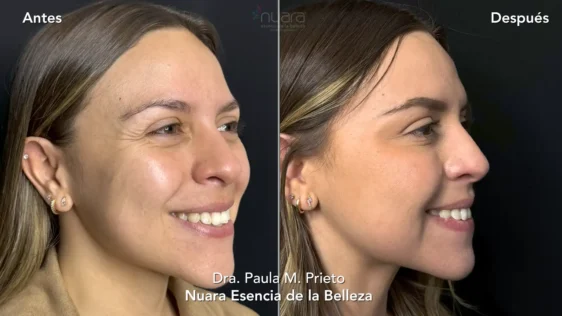 Toxina Botulinica l Nuara Bellleza lineas arrugas antes despues toxina botulinica Nuara Belleza
