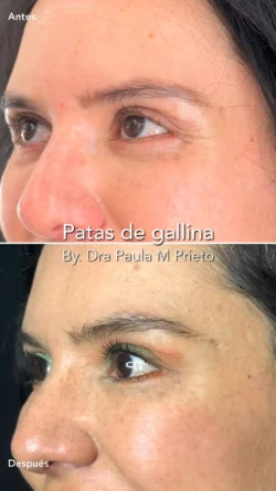 patas de gallina toxina botulinica Nuara Belleza