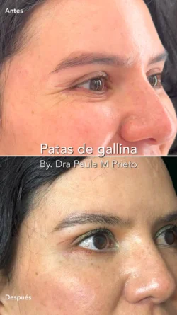 patas de gallina toxina botulinica nuara belleza Nuara Belleza