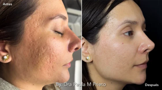 Peeling Facial l Nuara Esencia de la Belleza peeling acne dra paula m prieto Nuara Belleza