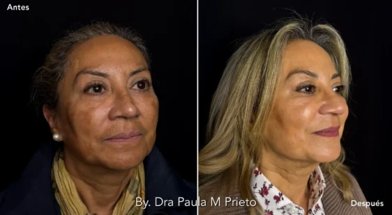 Peeling Facial l Nuara Esencia de la Belleza peeling manchas dra paula m prieto Nuara Belleza