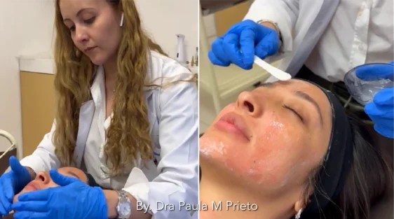 Peeling Facial l Nuara Esencia de la Belleza peeling novias dra paula m prieto Nuara Belleza