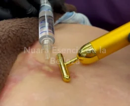 Queloides con Enzimas
