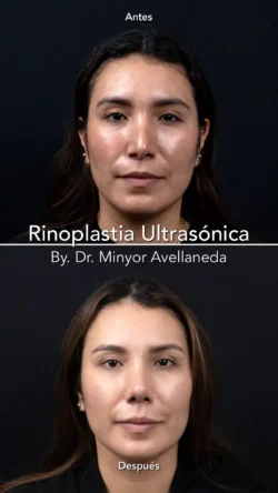 Rinoplastia Ultrasónica Secundaria by Minyor Avellaneda resultado rinoplastia secundaria antes despues femenino frontal bogota dr minyor avellaneda Nuara Belleza