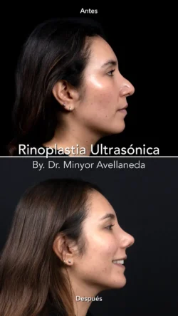 Rinoplastia Ultrasónica Secundaria by Minyor Avellaneda resultado rinoplastia secundaria antes despues femenino lateral bogota dr minyor avellaneda Nuara Belleza