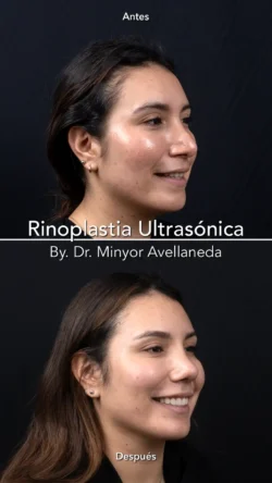 Rinoplastia Ultrasónica Secundaria by Minyor Avellaneda resultado rinoplastia secundaria antes despues femenino tres cuartos bogota dr minyor avellaneda Nuara Belleza