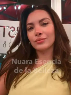 Rinoplastia Ultrasónica Secundaria - Caso Éxito Bogotá Resultado final de rinoplastia ultrasónica secundaria en Bogotá para una definición nasal natural y armónica.