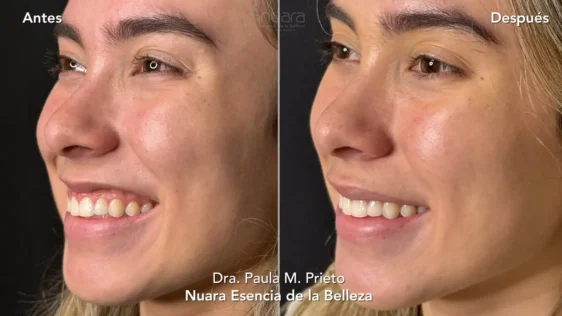 Toxina Botulinica l Nuara Bellleza sonrisa gingival antes despues toxina botulinica Nuara Belleza