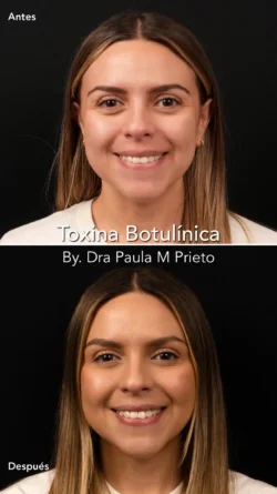 toxina botulinica frontal nuara belleza Nuara Belleza