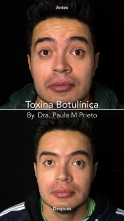 toxina botulinica hombre frontal nuara belleza Nuara Belleza