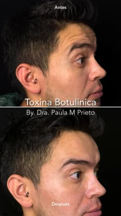 toxina botulinica hombre nuara belleza Nuara Belleza