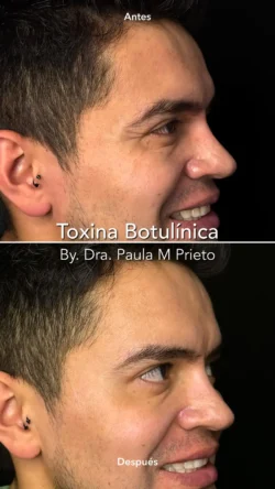 toxina botulinica hombre tres cuartos nuara belleza Nuara Belleza