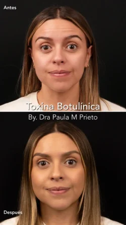 toxina botulinica nuara belleza Nuara Belleza
